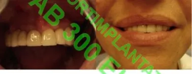 5 üzleti kép SOFORTIMPLANTATE, SOFORT BELASTBARE ZAHNIMPLANTATE, IMPLANTOLOGIE DR CZÍNER ZAHNARZTPRAXIS Fogászat, fogszabályzás ban/ben Sopron GS