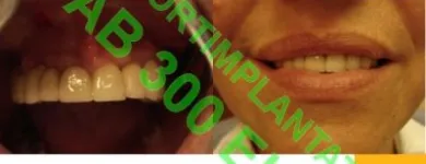 6 üzleti kép SOFORTIMPLANTATE, SOFORT BELASTBARE ZAHNIMPLANTATE, IMPLANTOLOGIE DR CZÍNER ZAHNARZTPRAXIS Fogászat, fogszabályzás ban/ben Sopron GS