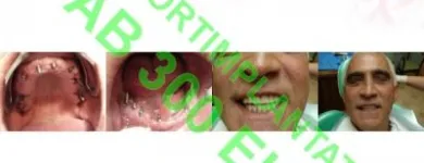 7 üzleti kép SOFORTIMPLANTATE, SOFORT BELASTBARE ZAHNIMPLANTATE, IMPLANTOLOGIE DR CZÍNER ZAHNARZTPRAXIS Fogászat, fogszabályzás ban/ben Sopron GS